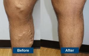 Guide to Varicose Vein Treatments & Which Works Best For You