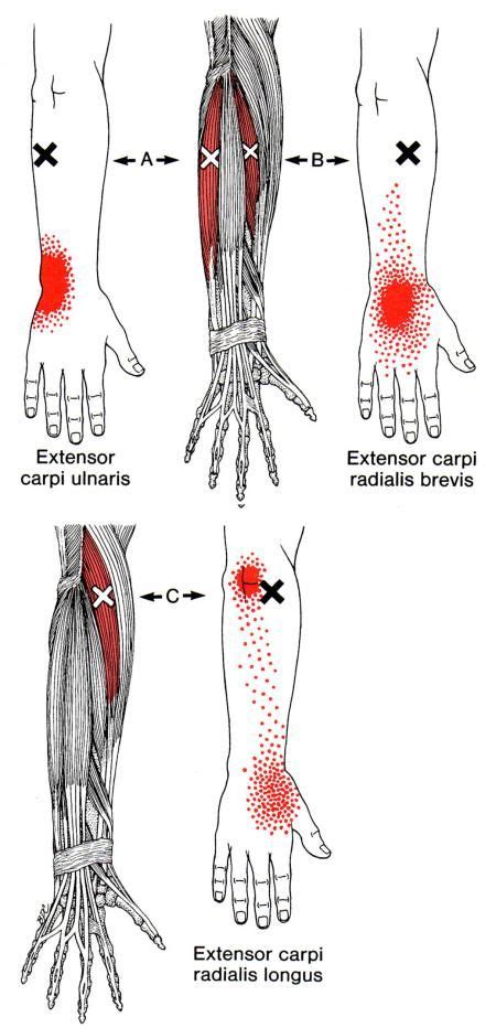 Pin on Health Myofascial Release Trigger Point