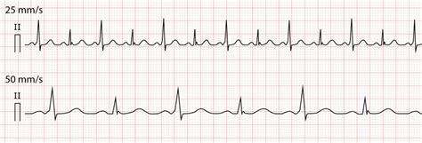 Pre-excitation, Atrioventricular Reentrant (Reentry) Tachycardia (AVRT ...