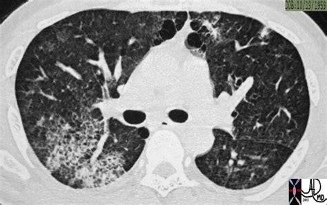 Honeycomb Change | Lungs