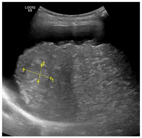 Liver Fibrosis Ultrasound