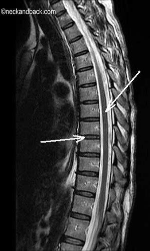 Normal MRI of Thoracic Spine | Donald Corenman, MD | Color… | Flickr