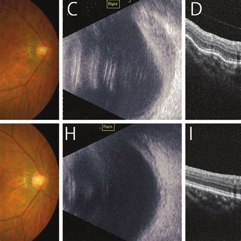 Findings of slit-lamp examination and imaging before and after ...