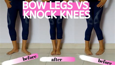 How To Correct Bow Legs In Adults - Bow Legs vs. Knock Knees - video ...