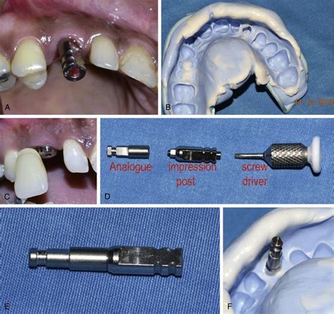 Implant impressions and prosthetics | Pocket Dentistry