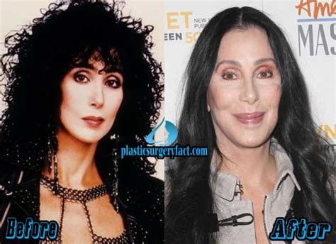 Cher Plastic Surgery Before and After Photos