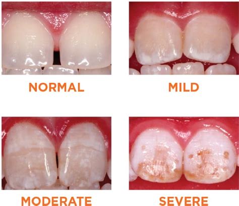 Enamel What??? - Enamel Hypoplasia Q & A | RPDO