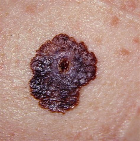 Superficial Spreading Melanoma