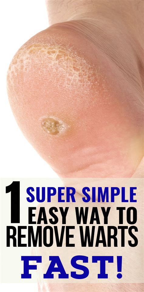 The Easiest Way to Get Rid of Warts Naturally in 2020 | Home remedies for warts, Get rid of ...