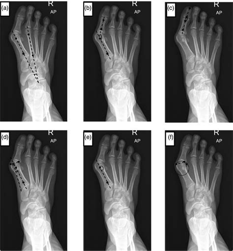 Reliability improvement in Hallux Valgus measurement using weight-Bearing CT scan - Suwimol ...