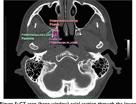 Figure 5 from Clinical functional anatomy of the pterygopalatine ganglion, cephalgia and related ...