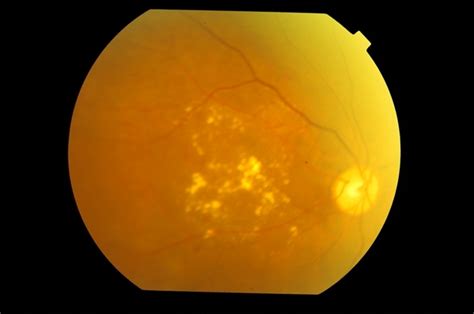 Exudative Diabetic Maculopathy - Retina Image Bank