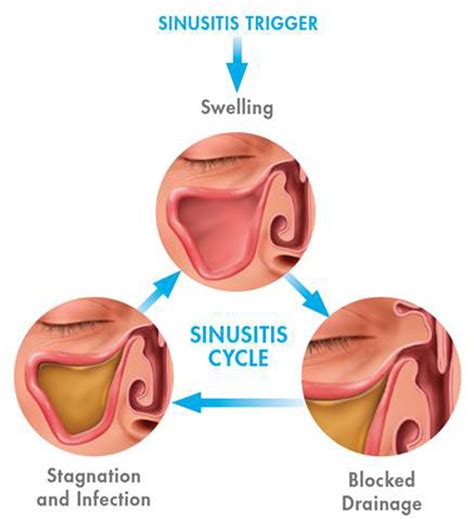 What Causes My Sinus Issues? – Sahasra ENT Clinic