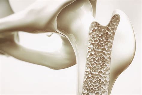 6 Bone Diseases You Should Know About