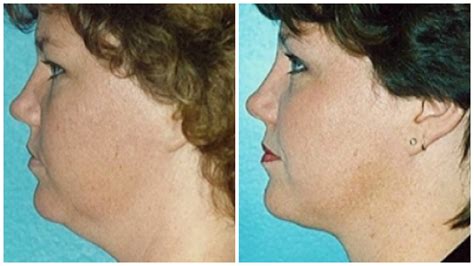 How to Get Rid of a Double Chin: 19 Facts About Chin & Facial Liposuction