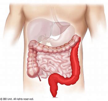 Ulcerative colitis | IBD Clinic