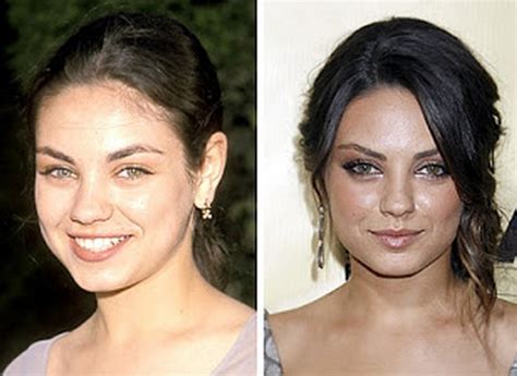 Mila Kunis Nose Job Plastic Surgery Before and After