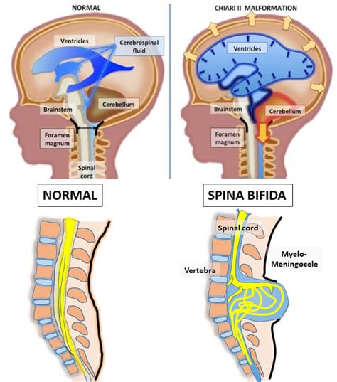 Conditions We Treat: Spina Bifida | Johns Hopkins Center for Fetal Therapy