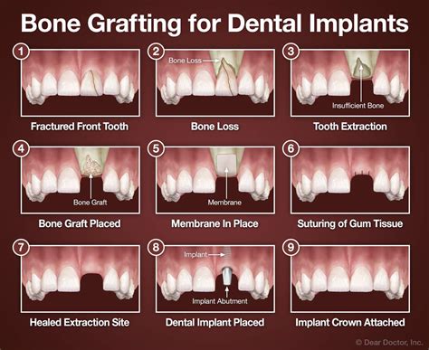 Gum & Bone Graft | Smile By the Station Dentistry | Seattle Washington