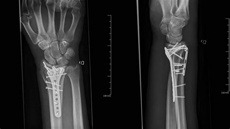 Want to Learn How To Manage a Distal Radius Fracture from Start to ...