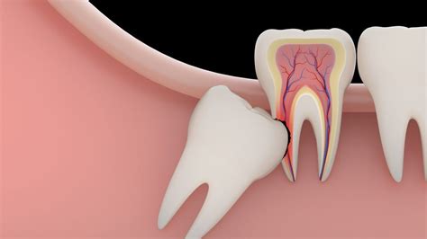 How to Deal with Wisdom Teeth Pain - Wisdom Dental Emergency