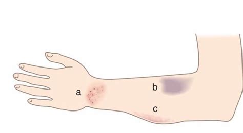 Contusion Vs Hematoma