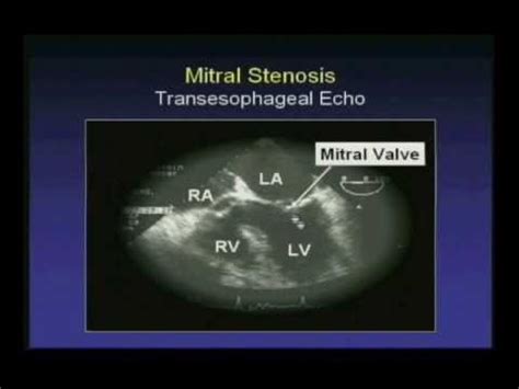 Rheumatic Mitral Stenosis - Transesophageal Echocardiogram - YouTube