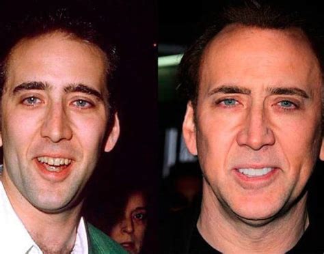 Nicholas Cage before and after dental work. An improvement ? # ...