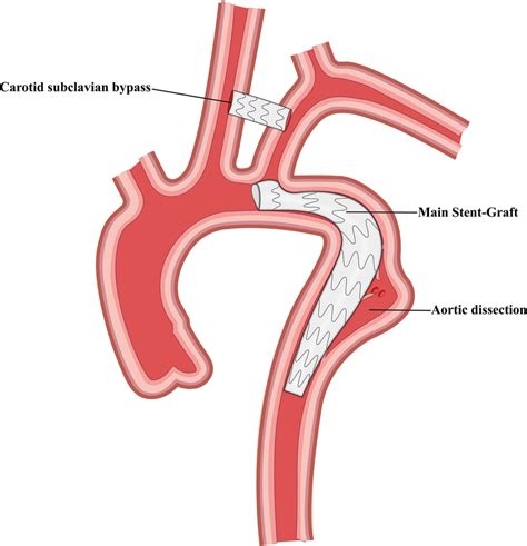 Schematic representation of carotid subclavian bypass and thoracic... | Download Scientific Diagram