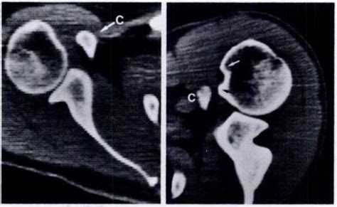 CT scan of a normal shoulder in the transverse plane of the body at the... | Download Scientific ...