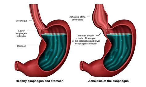 Cary Gastroenterology Associates | What to Know About Esophageal…