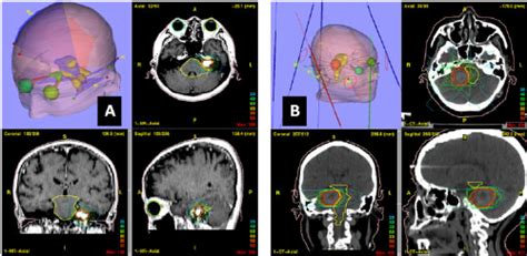 A: Stereotactic radiosurgery (SRS) planning for brain tumor. B: Brain ...