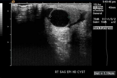 Spermatocele Ultrasound