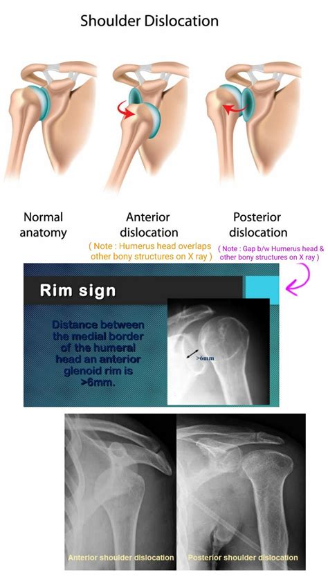 Anterior vs Posterior Shoulder dislocation on X ray ... | Radiology ...