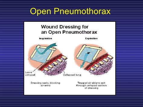 Treating Penetrating Chest Trauma