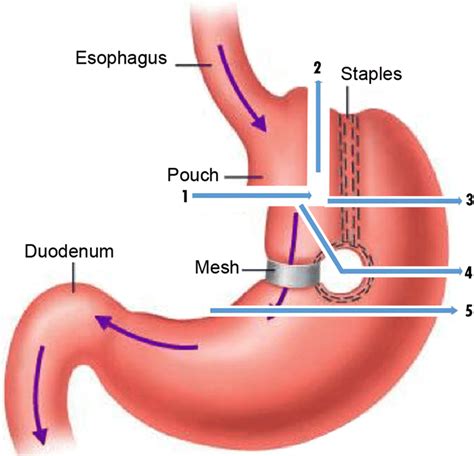 Vertical Banded Gastroplasty Before And After