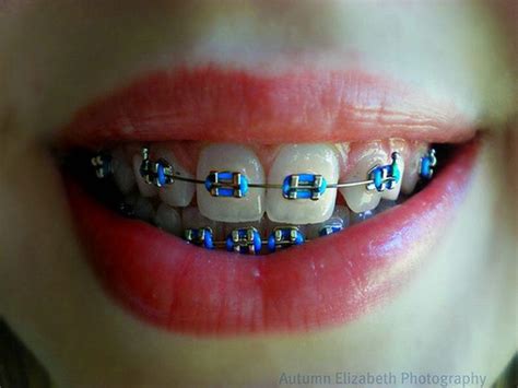 diy fake braces super easy - Nyla Guillen