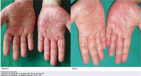 Management of Tinea Manuum - Fungal Infections - AntiinfectiveMeds.com