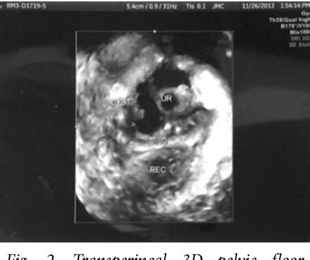 Figure 2 from Skene's gland duct cysts: The utility of vaginal ...