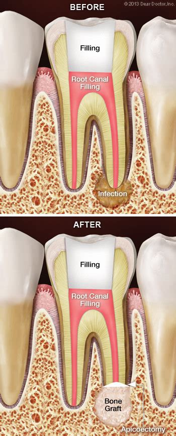 Root Canal Surgery (Apicoectomy) - My Primary Dental