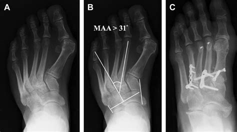 Metatarsalgia in Metatarsus Adductus Patients - Foot and Ankle Clinics