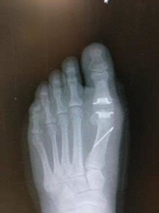 Big Toe Joint Pain Replacement Surgery [Best Recovery Time]