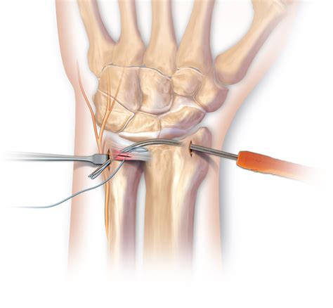 Arthrex - Arthroscopic TFCC Repair using the Micro SutureLasso™ (Inside out / Outside in)