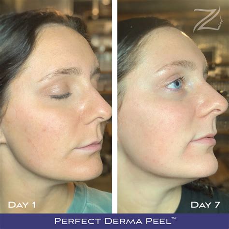 #WhatisWednesday: What is The Perfect Derma™ Peel? | Zero Gravity Med Spa NKY