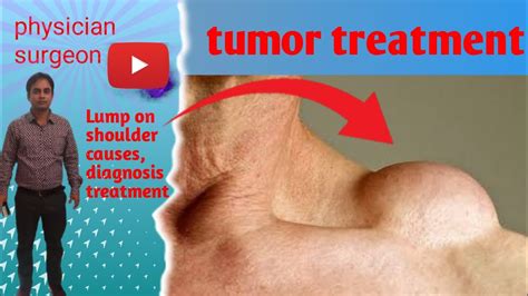 Lump on shoulder causes diagnosis treatment# physician doctor 🏥 ️ - YouTube