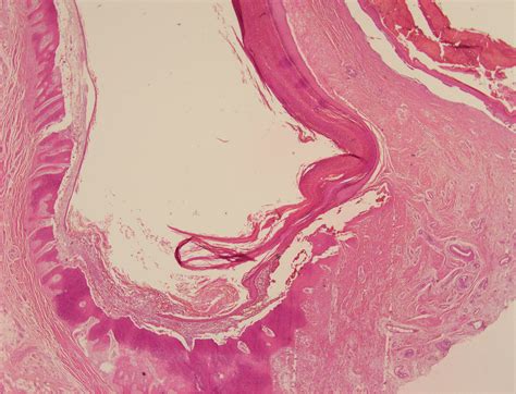 Epidermal Inclusion Cyst Histology