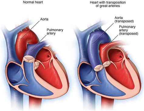 Transposition of the great arteries causes, symptoms, diagnosis ...