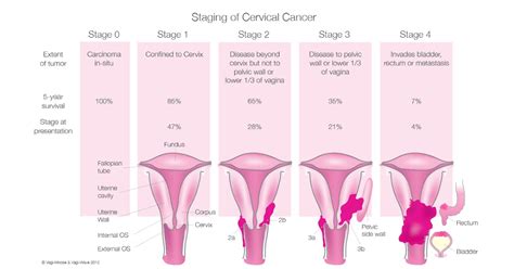 Symptoms Of Cervical most cancers before Menopause