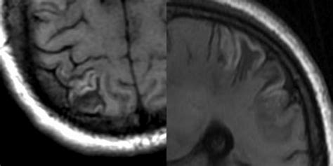 Dr Balaji Anvekar FRCR: Cortical laminar necrosis MRI