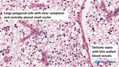 RENAL CELL CARCINOMA- CLEAR CELL TYPE - Pathology Made Simple